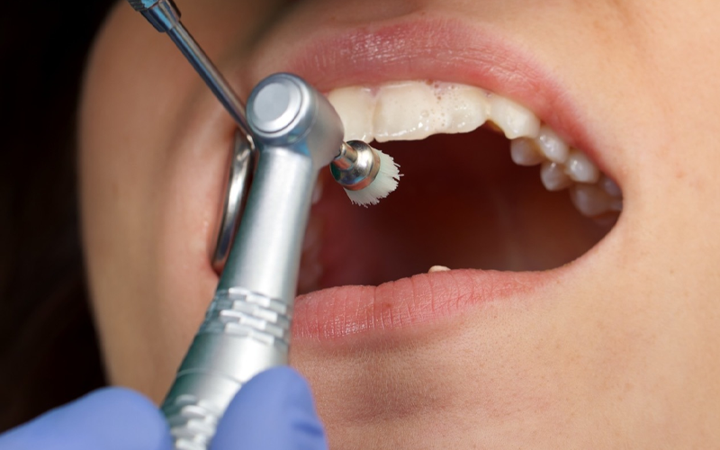 Why Dental Cleaning Matters