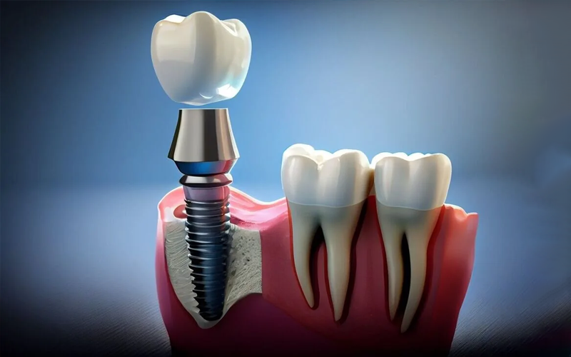 Affordable Dental Implants