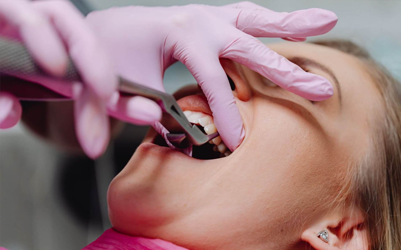 Dental Implants
